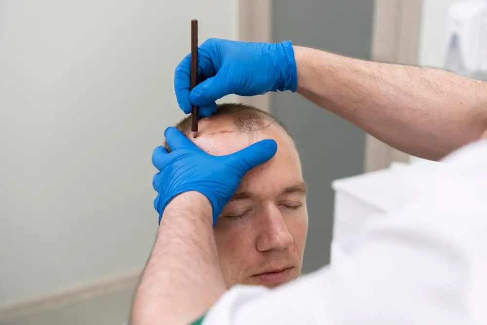 Choose the Right Hair Transplant Clinic