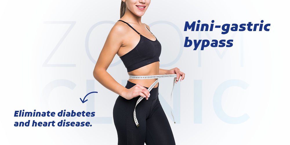 mini gastric bypass