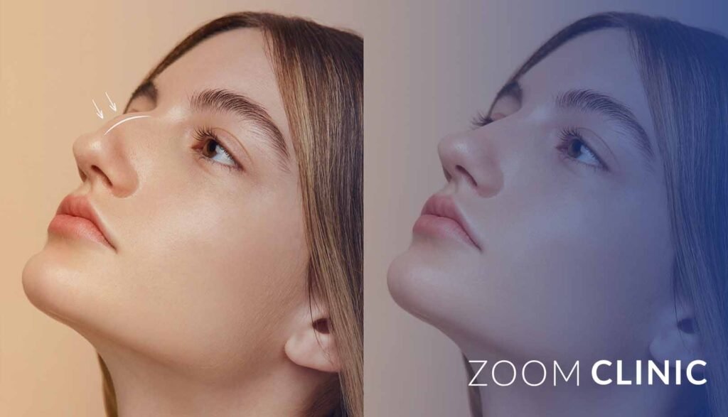 Nose Reduction at Zoom Clinic in Istanbul