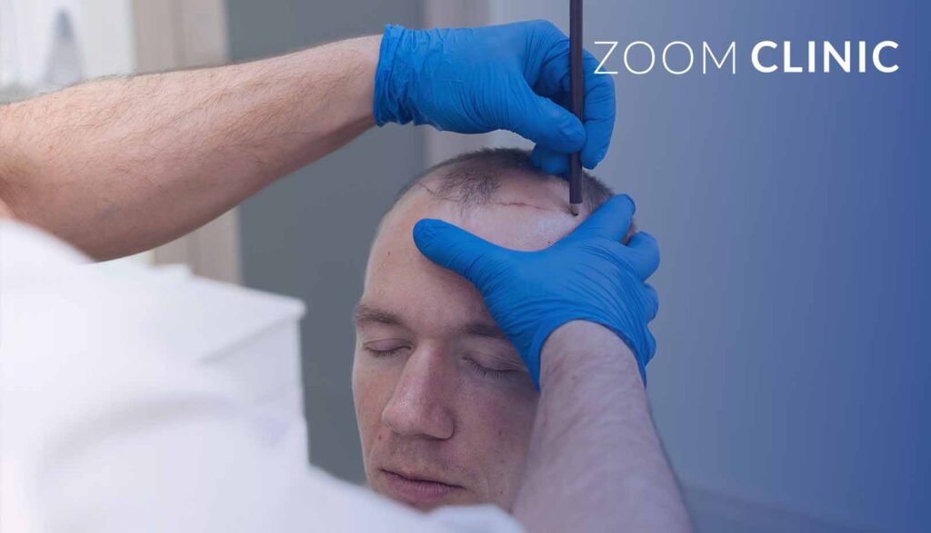 Preparing for Your Hair Transplant