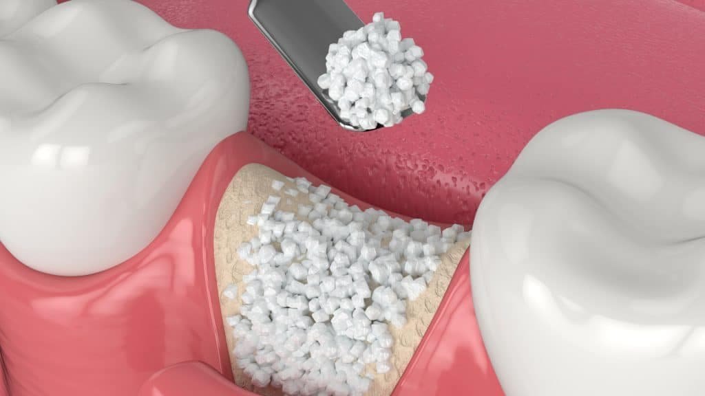  Role of Bone Grafting