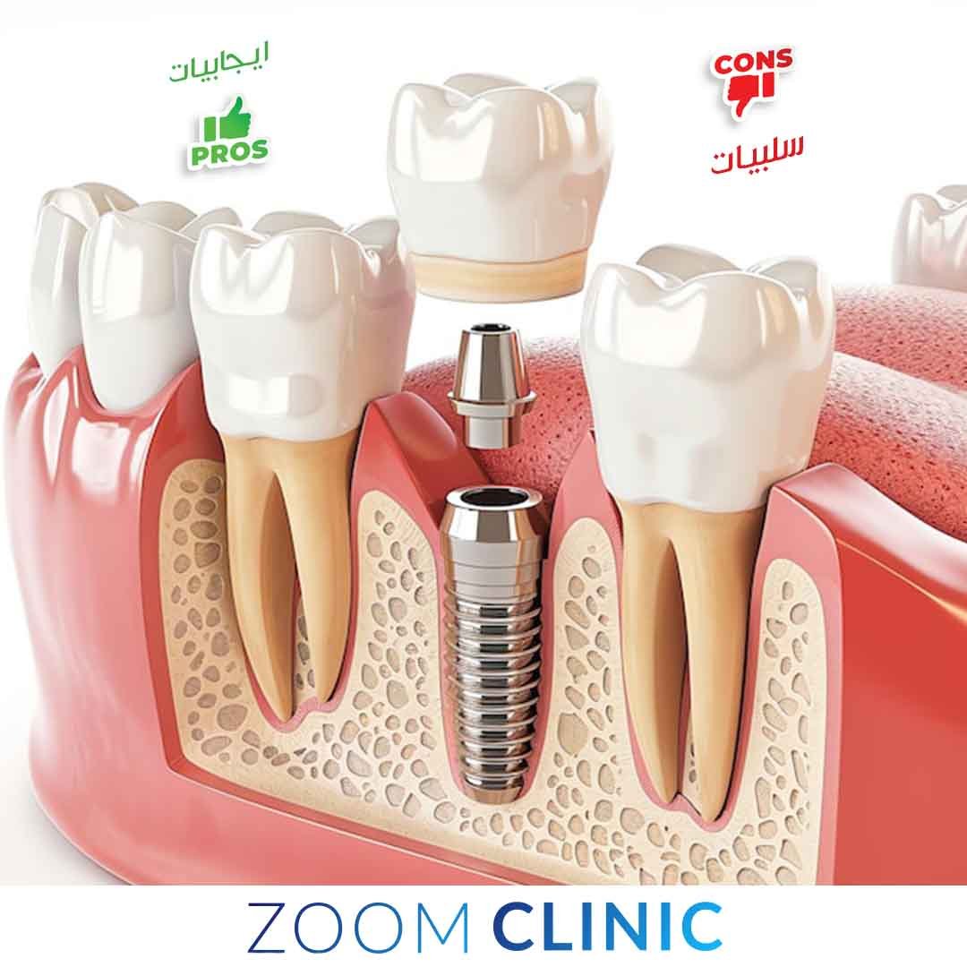 ايجابيات وسلبيات زراعة الأسنان في تركيا