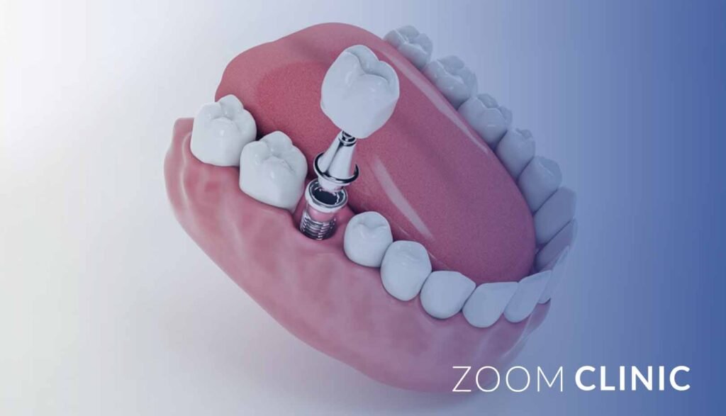 Cost of a Full Set of Dental Implants in Türkiye