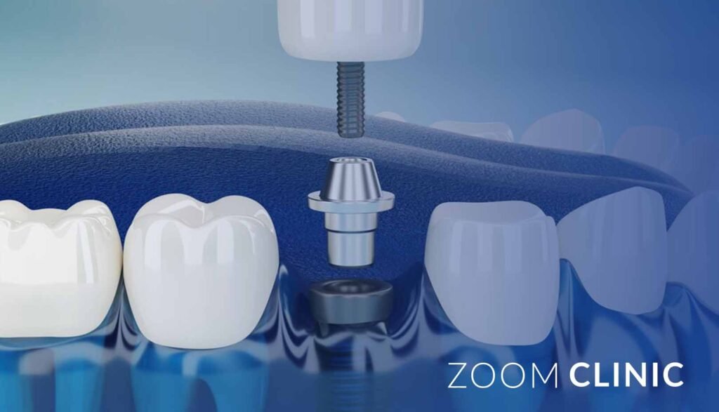 Cost of a Full Set of Dental Implants in Türkiye