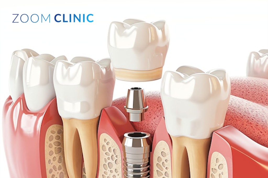 How Many Days dental implantation takes in Türkiye