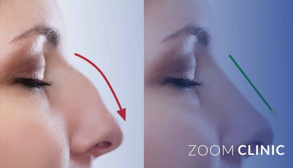 Rhinoplasty Techniques - Open and Closed Rhinoplasty
