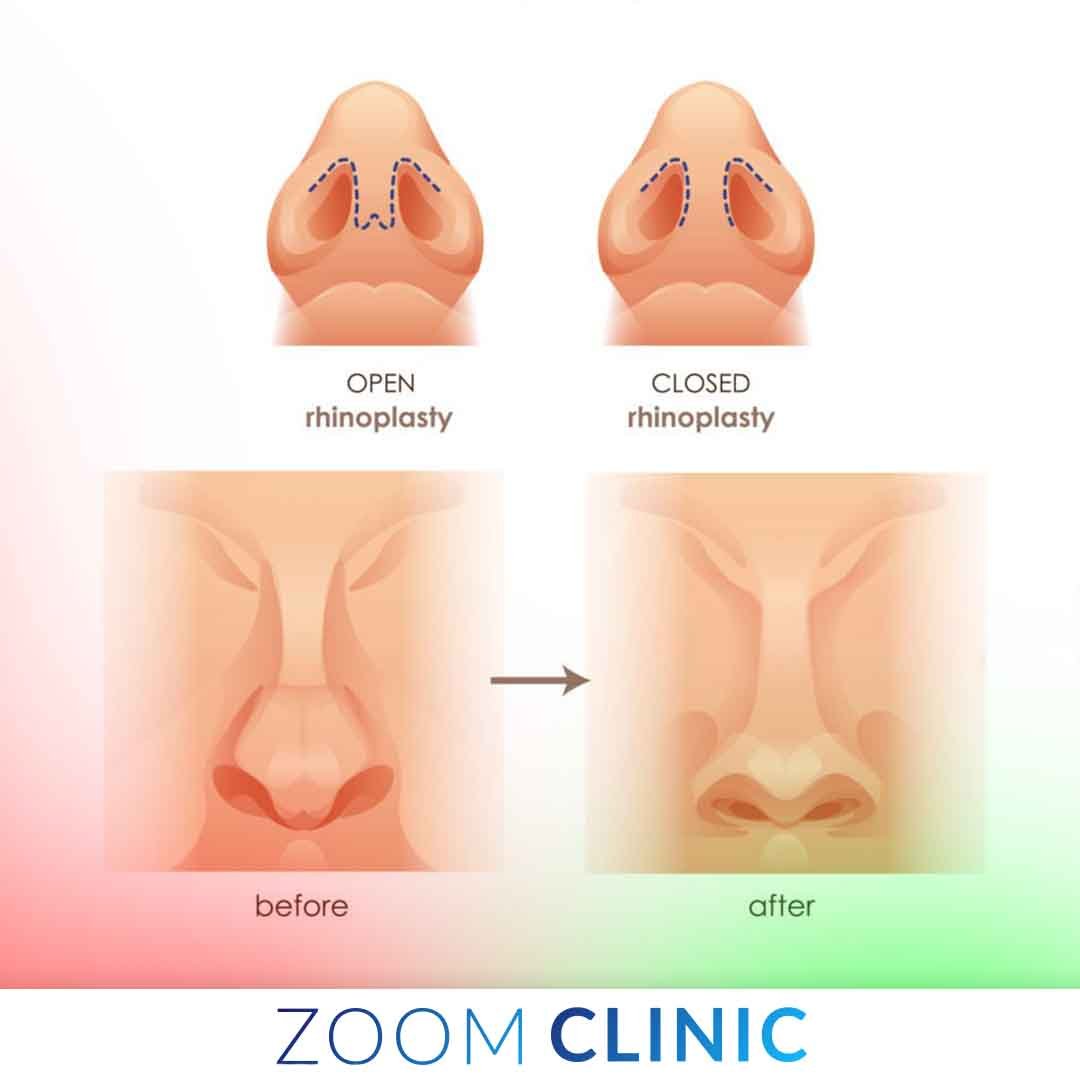 تقنيات تجميل الأنف - عملية تجميل الأنف المفتوحة والمغلقة