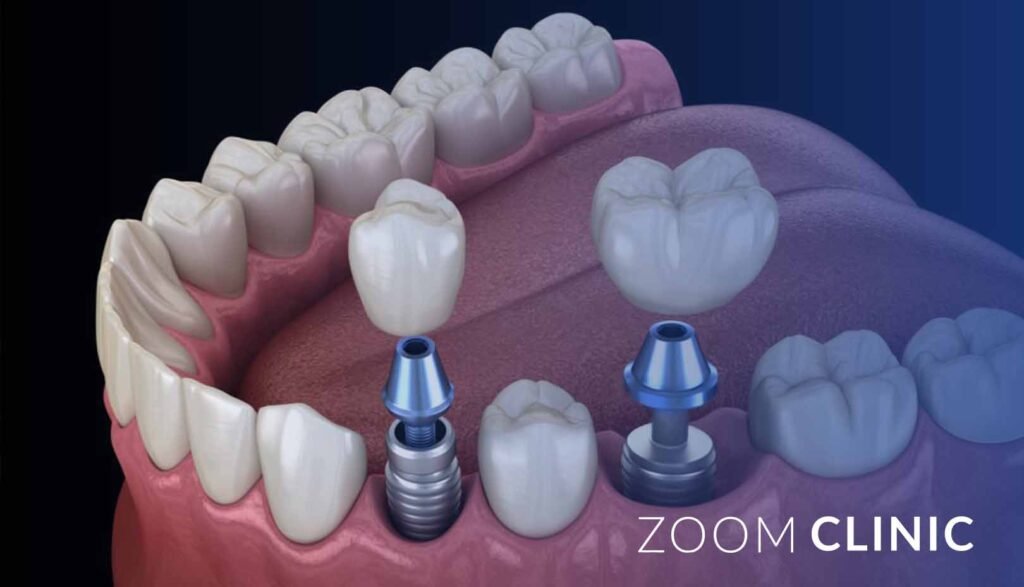 Which is better, a dental bridge or a dental implant?