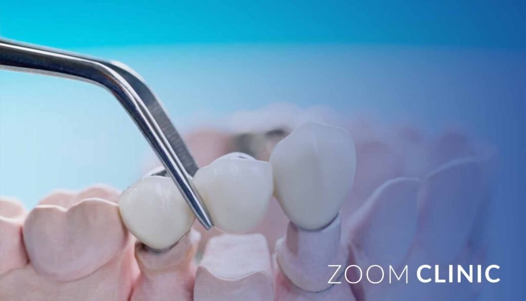 Which is better, a dental bridge or a dental implant?