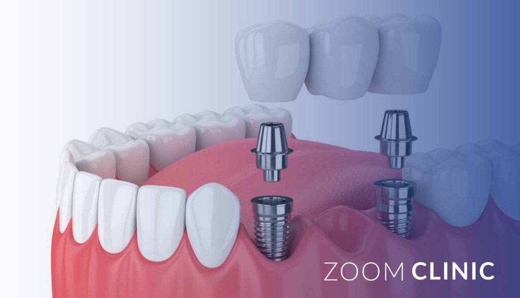 Which is better, a dental bridge or a dental implant?