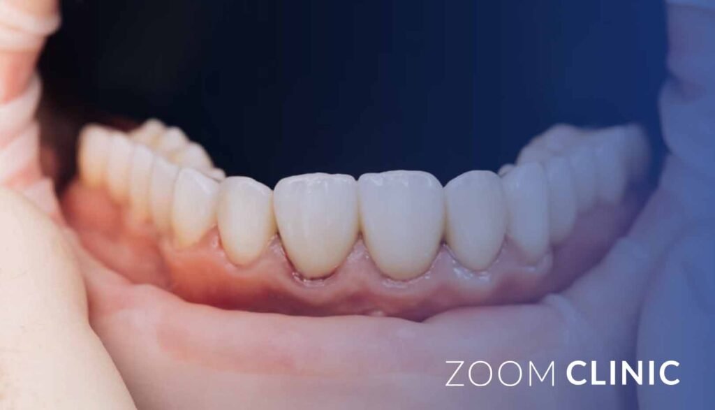 Anterior Dental Implants in Türkiye 