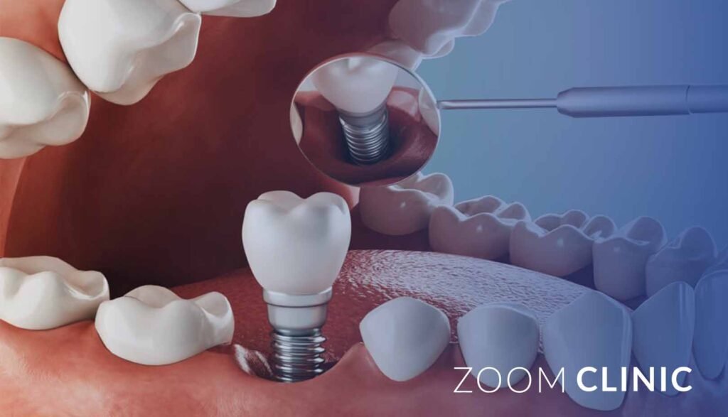 Dental Implants and Age