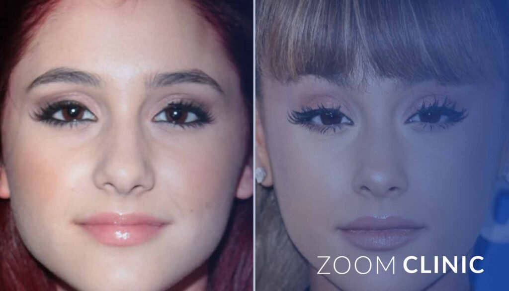 Celebrity Rhinoplasty Transformations