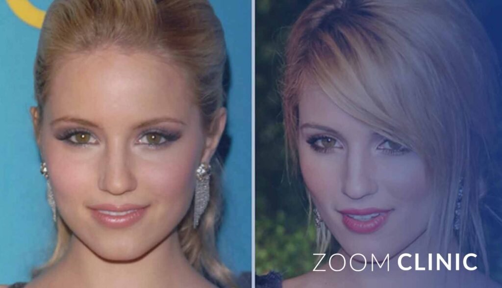 Celebrity Rhinoplasty Transformations