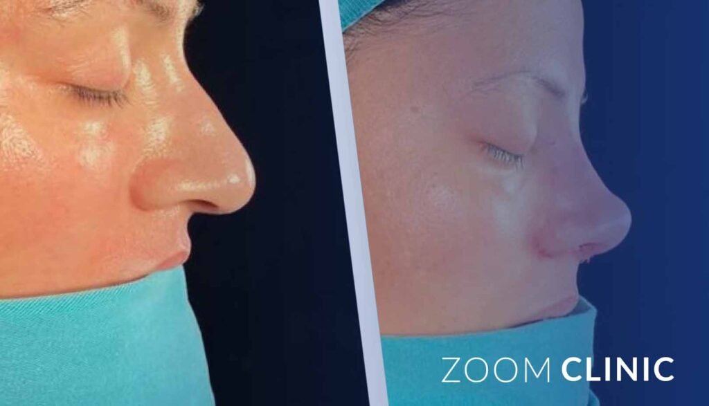 Non-surgical rhinoplasty