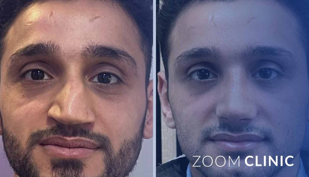 Rhinoplasty for men