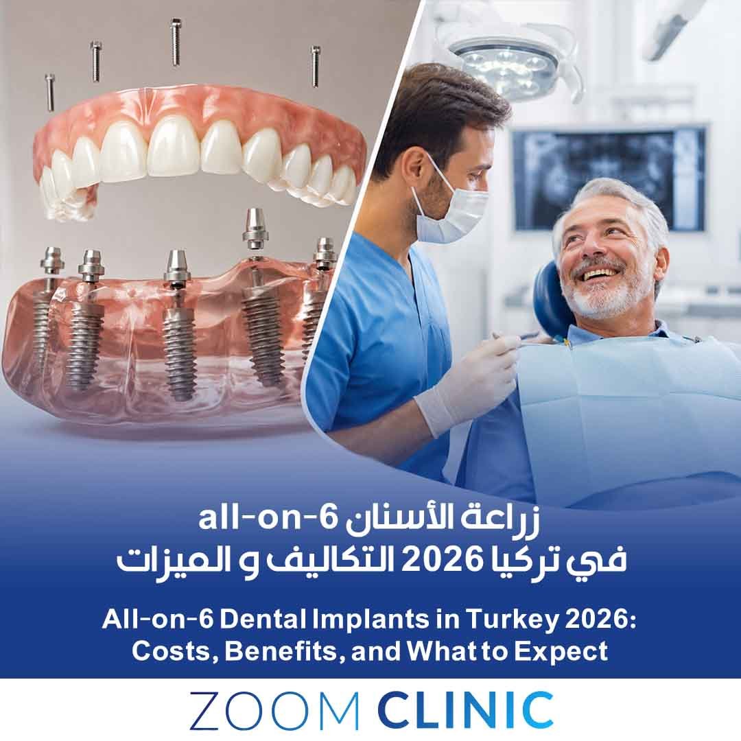 All-on-6 Dental Implants